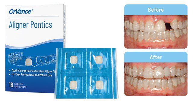 3af78f0b-orvance-aligner-pontics